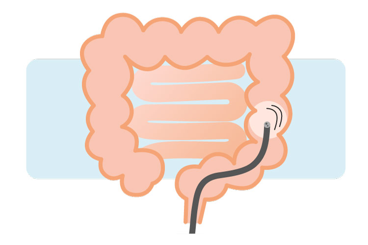 下部内視鏡（大腸カメラ）のイメージ